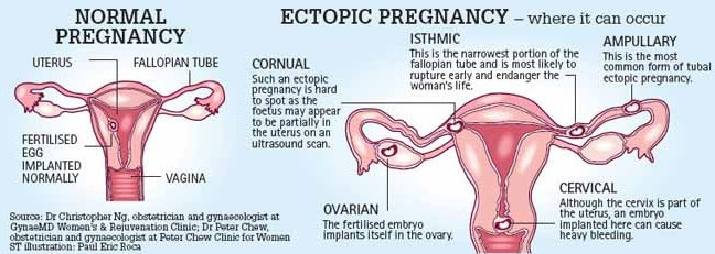 Kehamilan ektopik