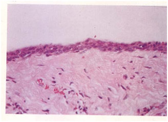 Kista Dentigerous. Batas kista yang khas terdiri dari sel skuamos epithelium non-keratinisasi berlapis yang ditunjang oleh jaringan fibrous yang tidak meradang