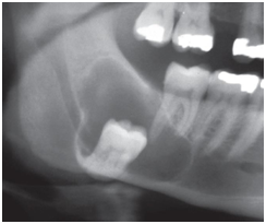 Gambaran radiografi Keratocystic Odontogenic Tumor