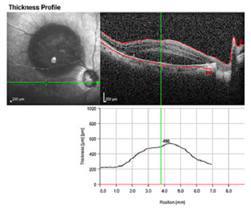 Optical coherence tomography pada aneurisma retina