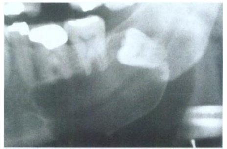 Kista Dentigerous Lateral