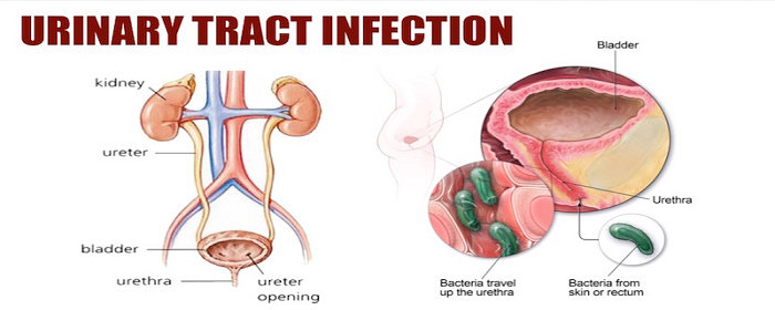 Infeksi saluran kemih